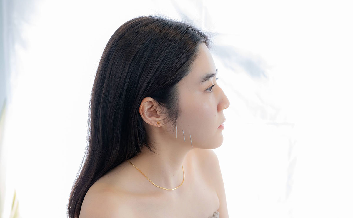 美容鍼4回コース